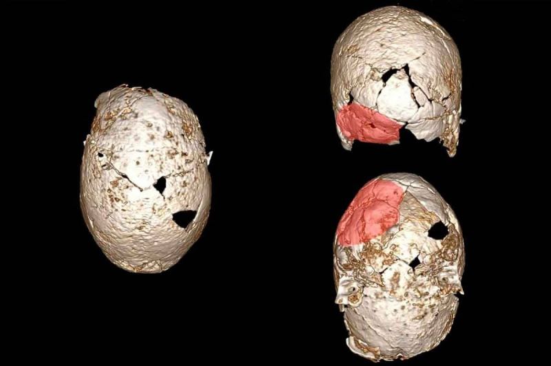 Study Reveals Ancient Italian Childcare Practices Linked to Flat Head Syndrome