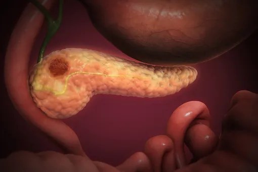 AI Detects Pancreatic Cancer Years Before Diagnosis